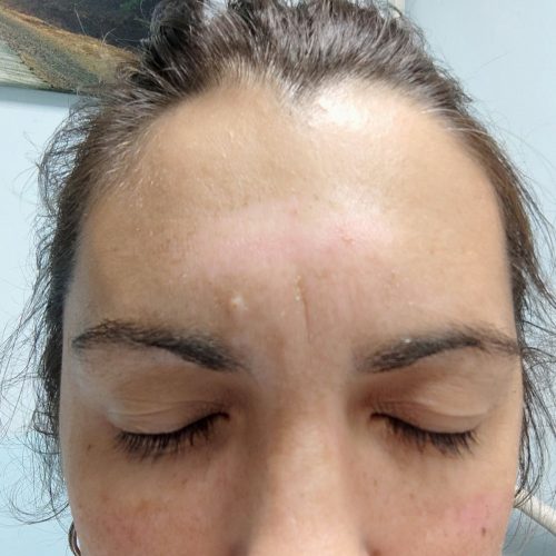 Hiperpigmentacija lica